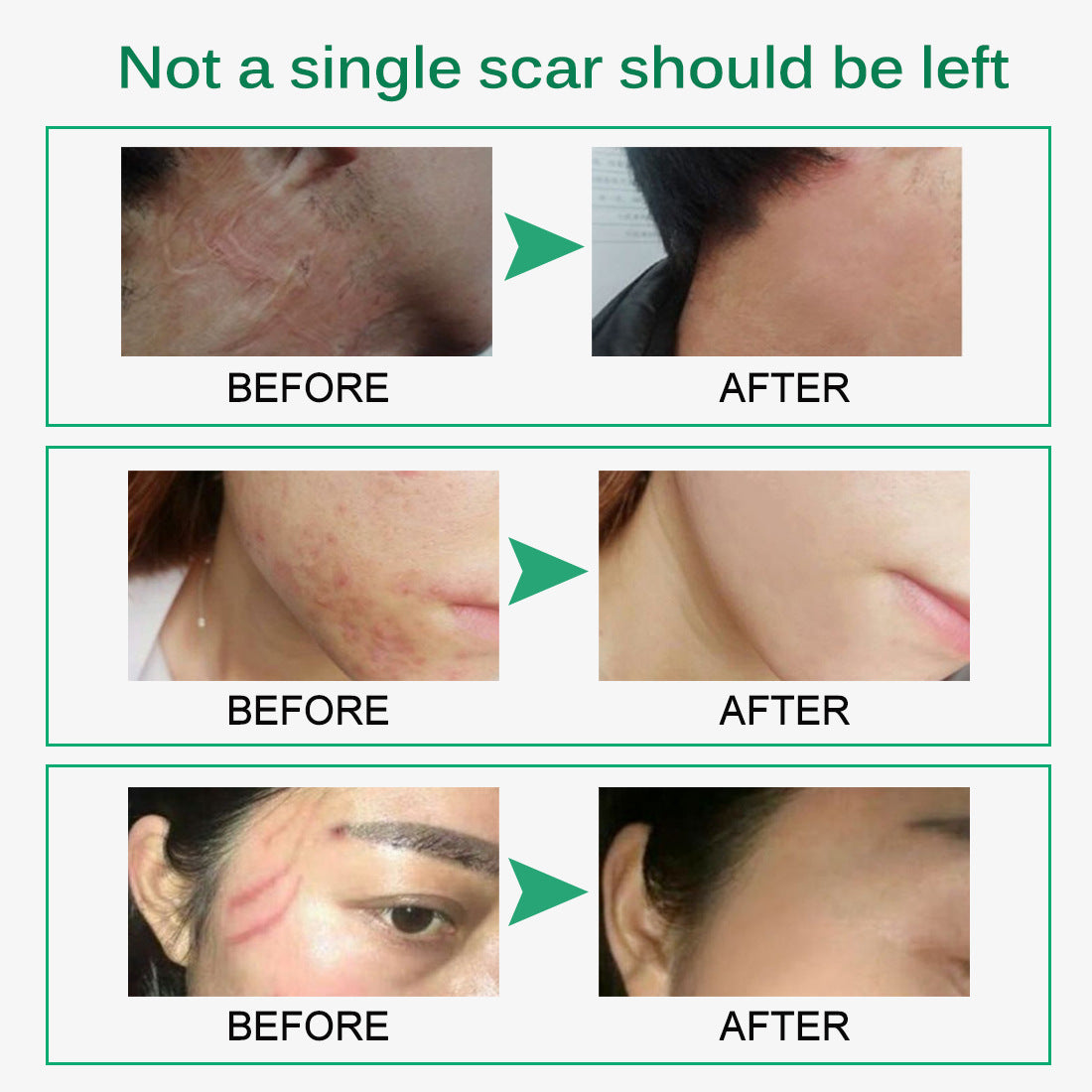 Skin Rebound Scarless Cream Scar Removal Cream Face Cream For Face Acne Scar Stretch Marks Skin Repair Face Cream